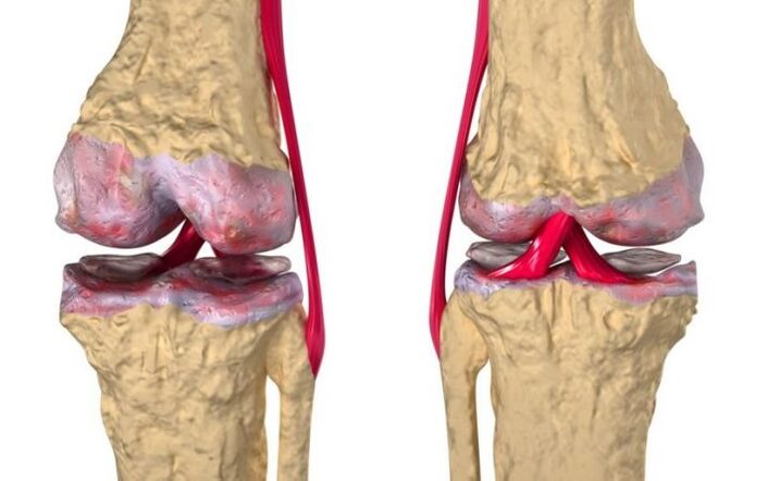 Arthrose des Kniegelenks