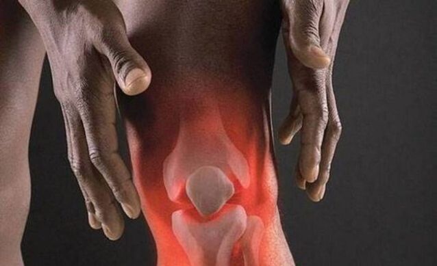 Mit der Arthrose geht ein entzündlicher Prozess im Kniegelenk einher